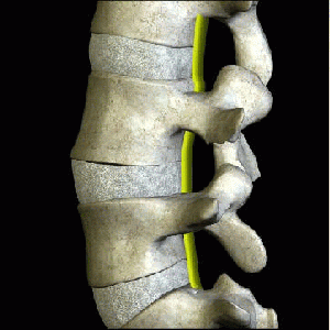 Cervical (Neck) Degenerative Disc Disease (DDD)