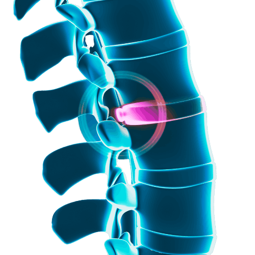 Heal Your Bulging Disc