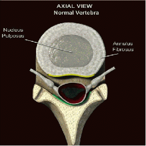 Herniated Disc
