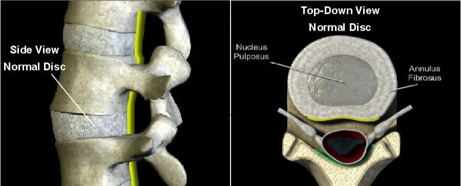 Cervical (Neck) Disc Symptoms