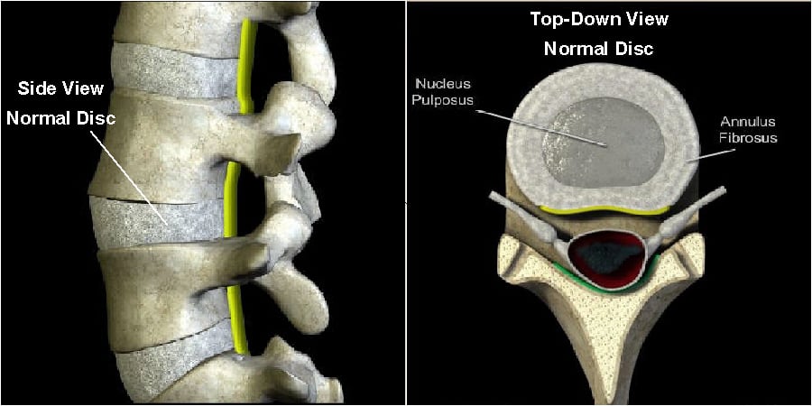 Lumbar (Low Back) Disc Symptoms